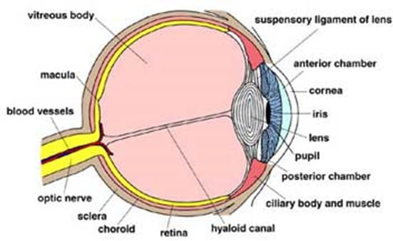 Illustration of a cataract.